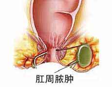 肛周脓肿