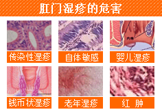 肛门湿疹的危害