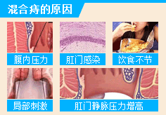 混合痔的原因
