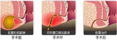 HCPT微创消融术