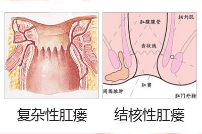 肛瘘图片