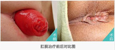 脱肛